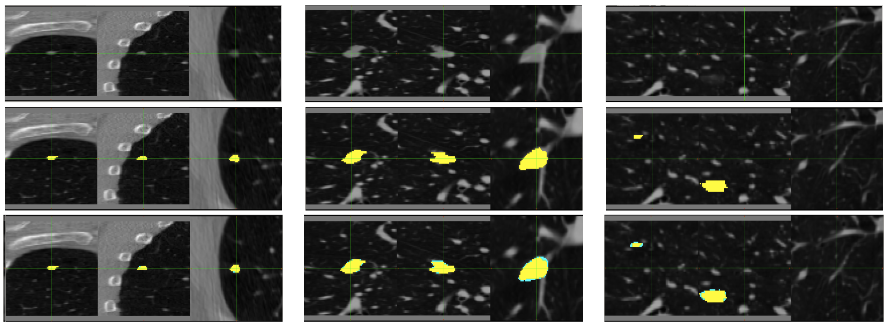 Segmentation of lung tumours by deep learning